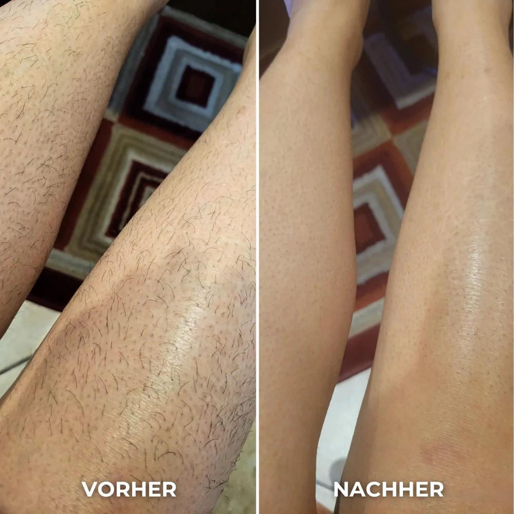 Lunica Pro - Dauerhafte Haarentfernung