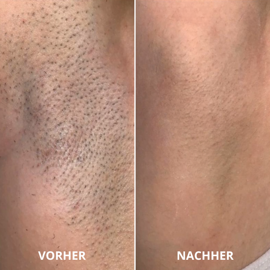 Lunica Pro - Dauerhafte Haarentfernung